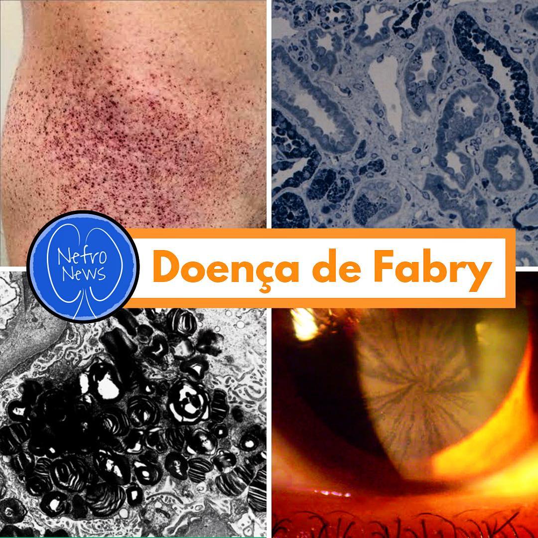 DOENÇA DE FABRY